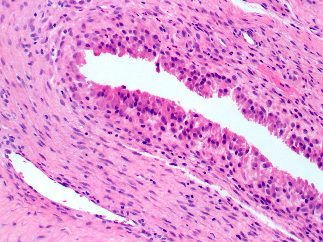 6-Synoviumhyperplasia