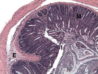 ATC-8MCD4-Diseased-Distal-1