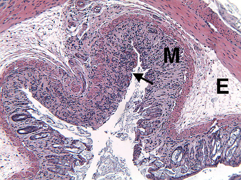 DSI1MDSS-Diseased-Distal