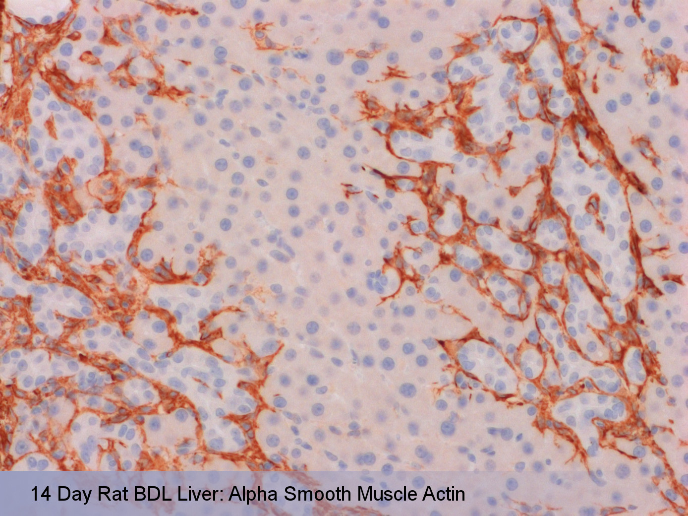 Liver-Fibrosis-SMA-annotated