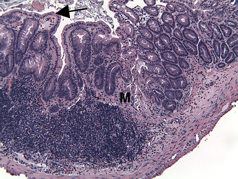 MTNBS2-Disease-Middle-Colon-100x