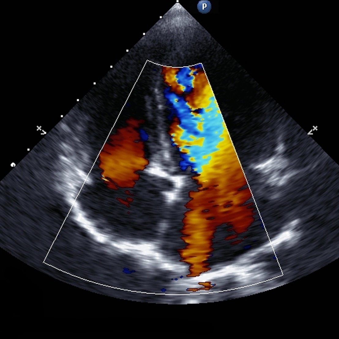 Myocardial Infarction Surgery