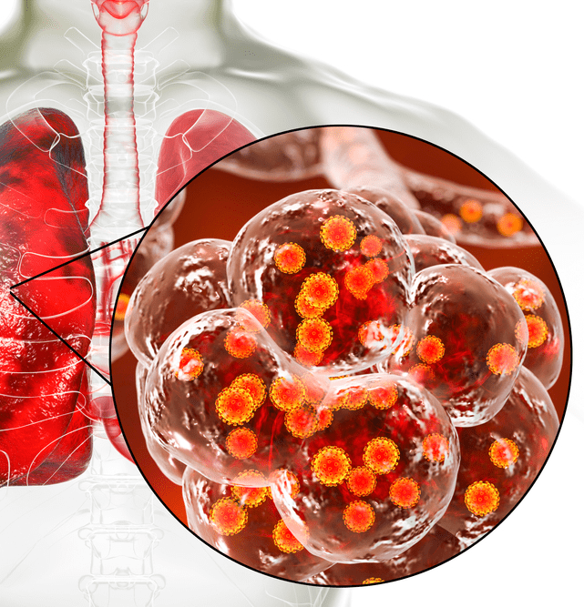 SARS CoV-2 Human Lungs COVID-19